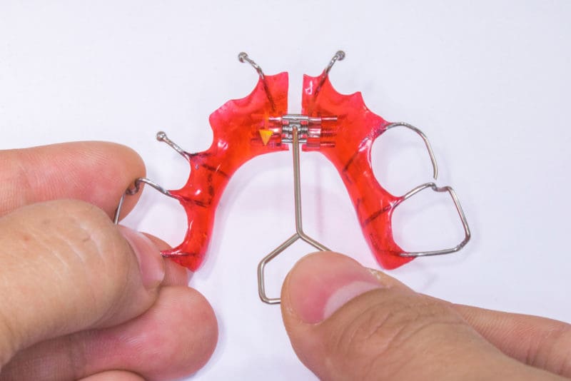 What is a Palatal Expander? Andros Orthodontics Tri Cities